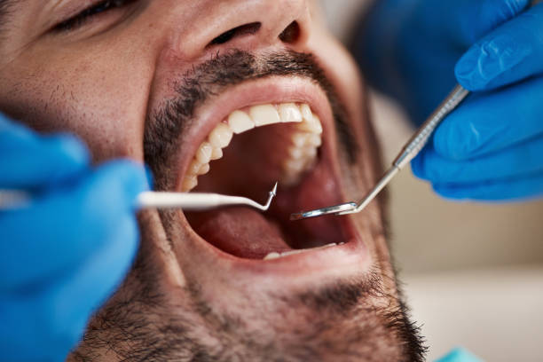 Best Emergency Treatment for Dental Infections or Abscesses in Florissant, MO