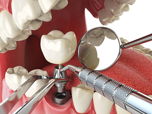 Best Urgent Care for Lost Fillings or Crowns in Florissant, MO